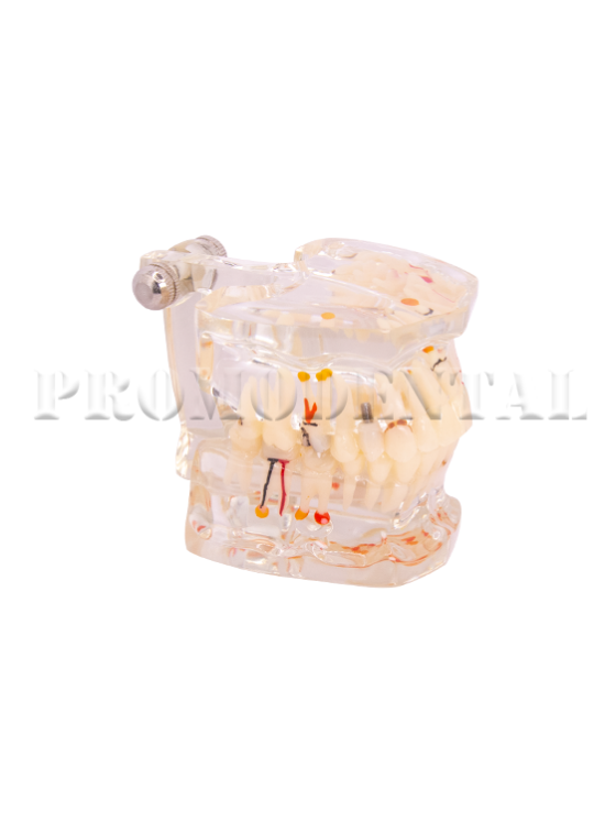 173-A0015-Pathology Model with half implant 173-A0015 - 2.png